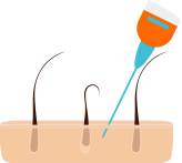 より効果的に発毛をご希望の方