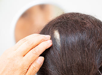 円形脱毛症とは?何が原因?