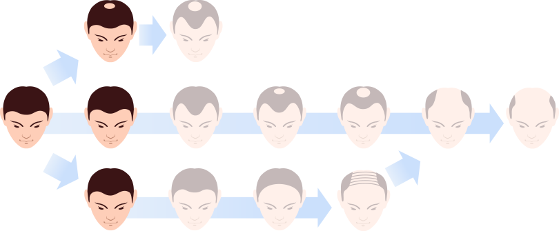 PLAN1 薄毛予防をしたい方